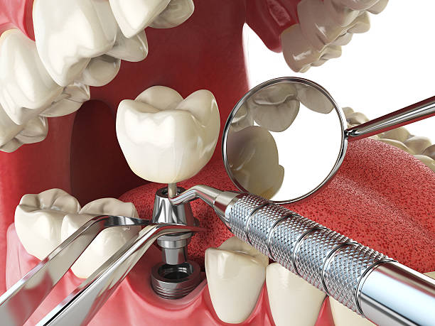 Best Emergency Dental Care for Abscessed Tooth in Ball Ground, GA